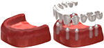 Brak wszystkich zębów - odbudowa za pomocą protezy umocowanej na stałe