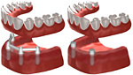 Brak wszystkich zębów - odbudowa za pomocą protezy ruchomej umocowanej na zatrzaskach