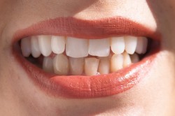 Wybielone zęby w górnym łuku zębowym
