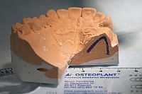 Przekrój wyrostka zębodołowego z zaznaczonym kształtem kości