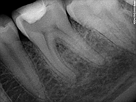 Ząb trzonowy dolny przed leczeniem endodontycznym