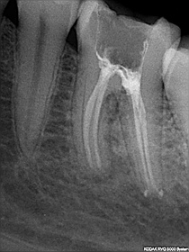 Ten sam ząb po wypełnieniu 4 kanałów korzeniowych
