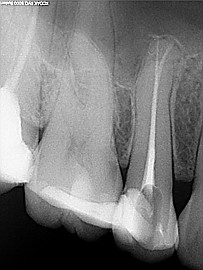 Ząb przedtrzonowy górny po leczeniu endodontycznym - wypełnione 2 kanały korzeniowe