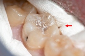 Próchnica w zębie trzonowym dolnym